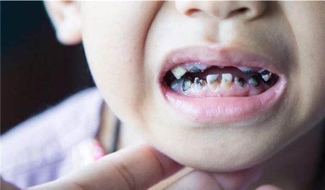 如何让孩子远离龋齿?日常3个预防措施应做好