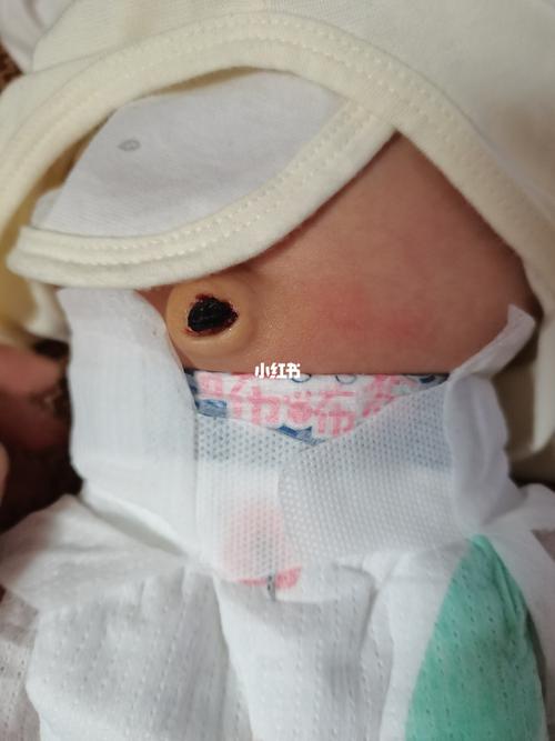 正常肚脐眼都是啥样的_宝宝日常_母婴_育儿经验