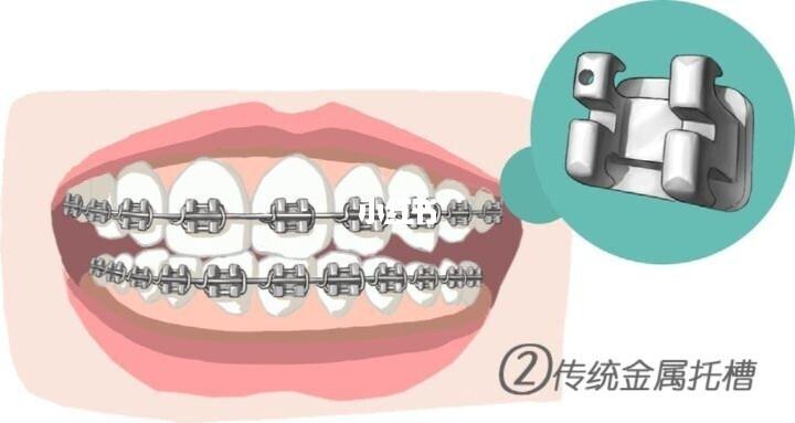 你以为矫正牙套只有4种类? no no no !