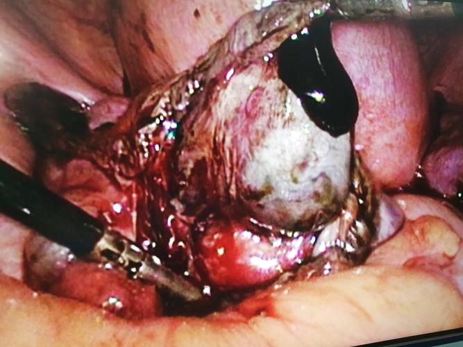 卵巢子宫内膜异位症又名卵巢巧克力囊肿