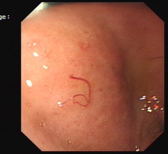 73岁菜农胃里藏13条虫医生:生吃蔬菜也可能染钩虫病