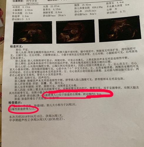 上面写的边缘性胎盘脐带入口,脐带入口位于胎盘的右侧