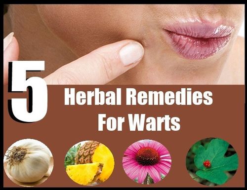 5 powerful herbal remedies for warts