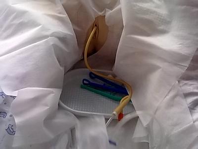 上门换尿管——济南家庭医生