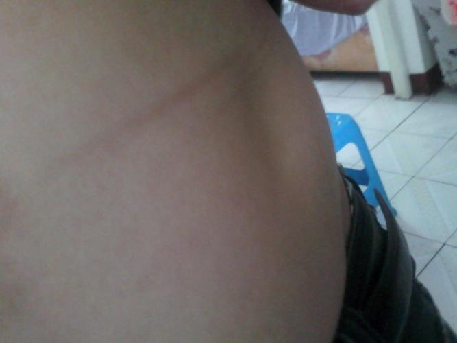 发张治愈后的照片给大家,腹部的脂肪瘤,预后留下的凹陷发现经过:感谢