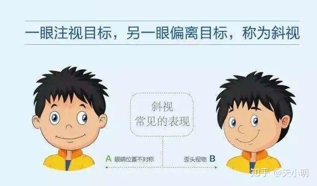 视力形成较大差异,双眼视物时,会习惯用较好视力的那只眼睛看远看近