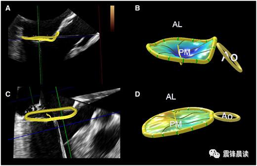 二尖瓣环的解剖,运动和临床意义(三)