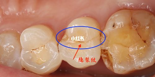 遇到牙隐裂,牙齿还有救吗?_郑州自由行热门攻略_郑州