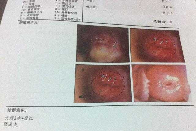 医生提醒:不想宫颈"受威胁",3件事提前注意,或能绕开宫颈癌