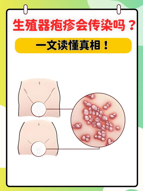 那么,生殖器疱疹到底会不会传染呢?
