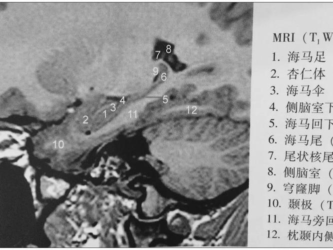 海马解剖结构与mri的诊断应用丨影像天地