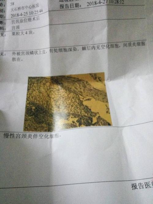 宫颈原位癌术后,活检报告,外被宫颈鳞状上皮,有处细胞深染,棘层内见