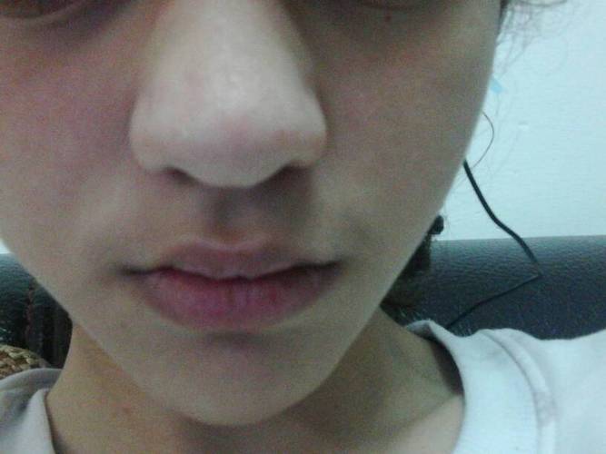 女鼻子太大怎么办?我还未成年