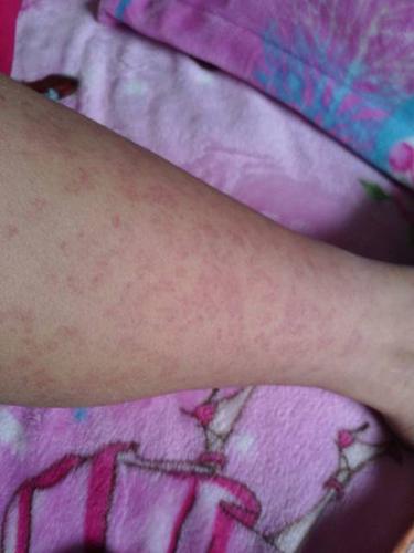 小腿上有小红斑点,不痛不痒,皮肤很光滑