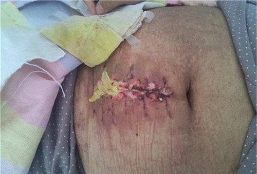 剖腹产刀口1个月后流脓, 医生吓一跳, 老公骂婆婆不是