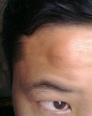 小时候比较贪玩把自己额头撞了,长了一个大包至今还没消失,按下去硬硬