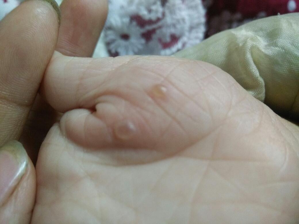 宝宝手上有几个透明的水泡是怎么回事,要紧吗?