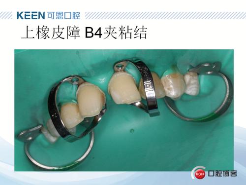 贴面橡皮障下的备牙和粘结