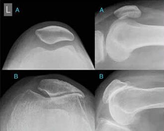 (2). 髌骨半脱位