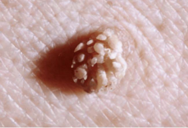 19岁女大学生感染hpv,肉芽疙瘩遍体,医生:80%就诊的都是大学生