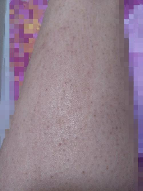 有人知道小腿这里是什么皮肤病吗?如何改善啊?