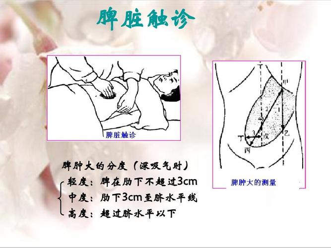 脾脏触诊 脾肿大的分度(深吸气时) 轻度:脾在肋下不超过3cm 中度:肋下