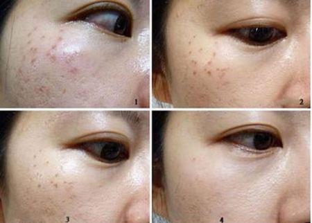 激光去日晒斑的效果怎么样呢