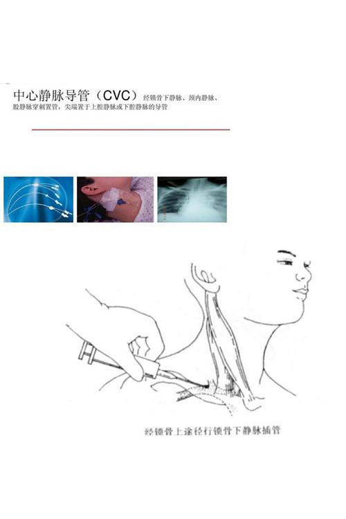 四,锁骨下静脉置管,颈内静脉置管,股静脉置管.