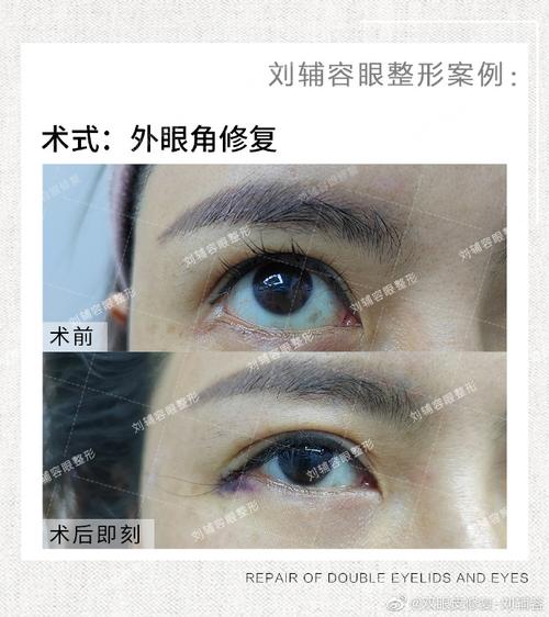 下的外眼角修复,给她进行一个缝合化处理#双眼皮修复##开眼角#修复