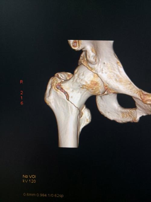 术前的三维重建图片