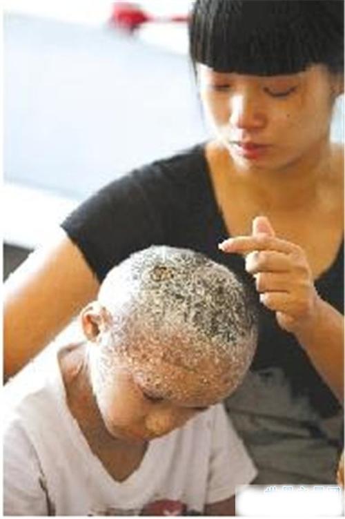 世界最奇怪的病这种病太恐怖了简直头皮发麻