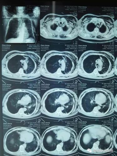 小切口解决大问题 胸腔镜下肺大泡切除