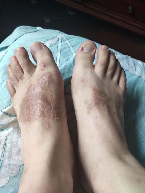 双脚背长顽固性湿疹,一直好不了怎么办?