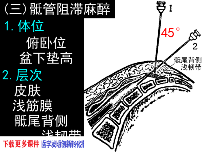 椎管解剖腰麻骶管麻醉基础