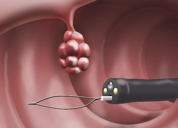 患上"肠息肉",大便时可能有3个"异常",为了健康不妨一看