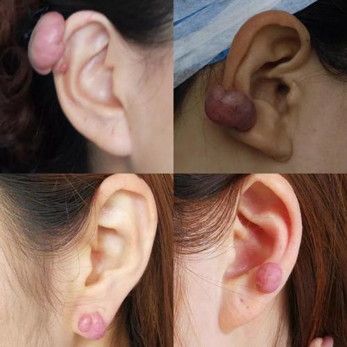 打耳洞导致疤痕疙瘩