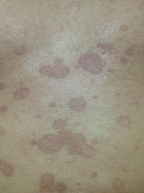 身上长红斑不疼不痒,一热就特别明显,早上起来就基本看不见