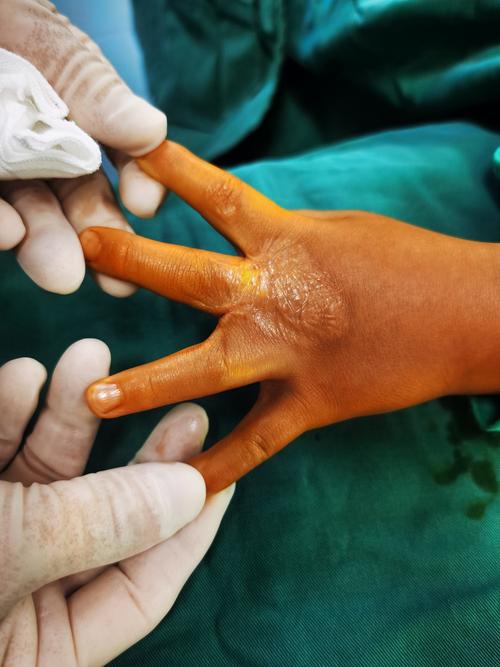 改变患儿一生-----指蹼成型术