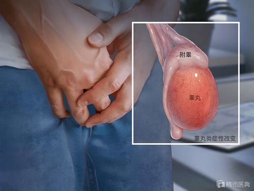 堪比女人生孩子|睾丸|附睾炎|阴囊