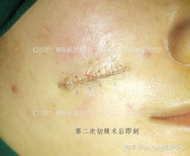 图1:儿时老鼠咬伤留下的面部疤痕 图2:第一次切除(切除了上半部分的
