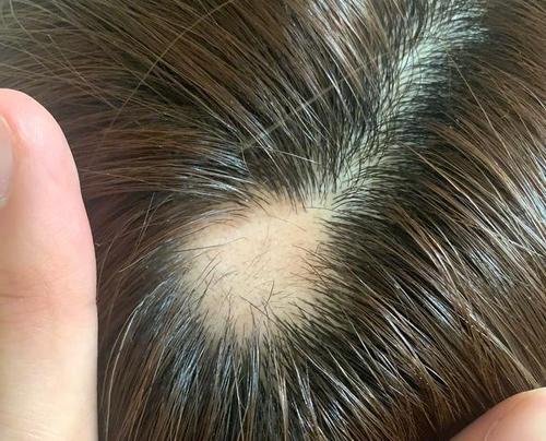 沈梦辰因过度焦虑导致斑秃,看见照片后,才懂艺人压力到底有多大