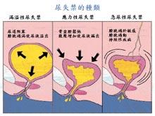 尿失禁