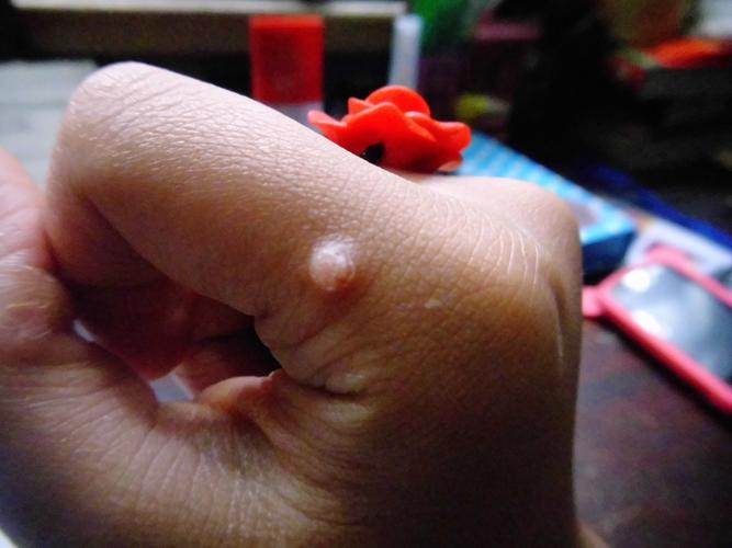 手上长肉痣怎么办