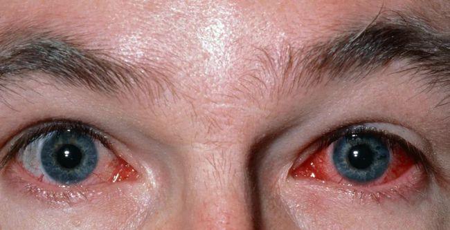 专家科普角膜炎和结膜炎有什么区别