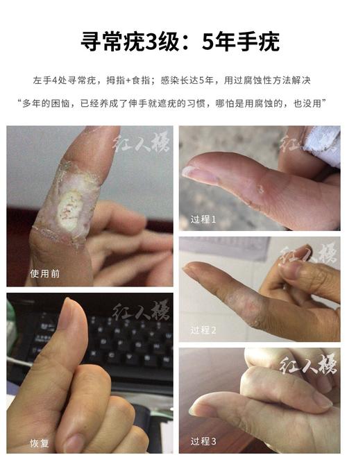 孙叔公红人榜——手足疣的手疣 寻常疣集锦_手部_hpv