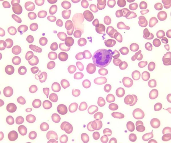 形态学报告中血小板应该如何描述|经验分享