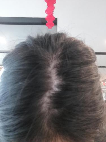 女,24岁,确诊脂溢性脱发,是满头均匀脱发,尤其是头顶,而且特别痒,发