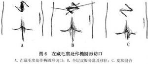 藏毛窦 词条正文 手术切除全部病变组织,游离肌肉和皮肤,完全缝合伤口