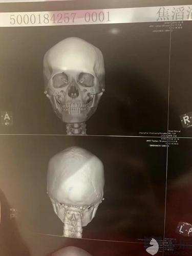 颧骨颧弓下颌角术后七个月多面部成畸形且不对称面颊凹陷