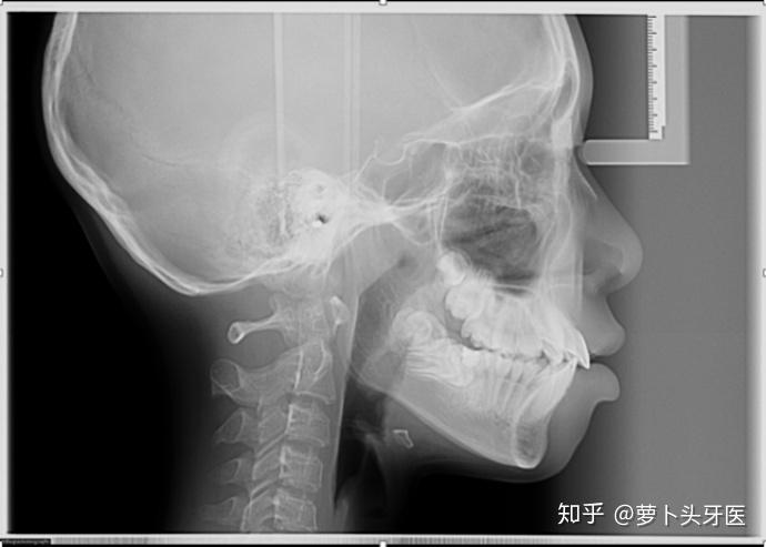 牙齿矫正科普大集合